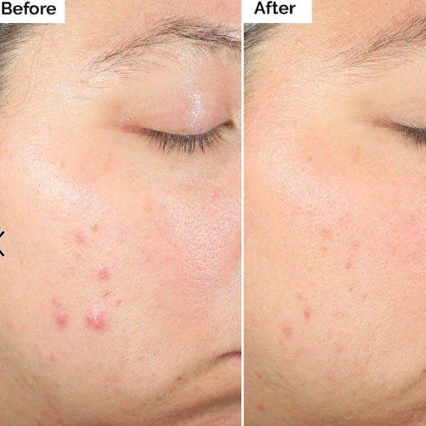 The Ordinary Salicylic Acid 2% Exfoliating Blemish Solution in Pakistan - Buy Vitamins